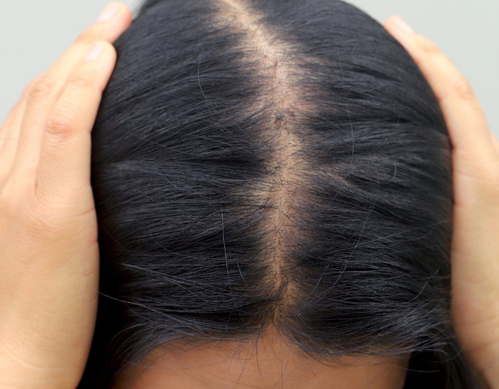 alopecia